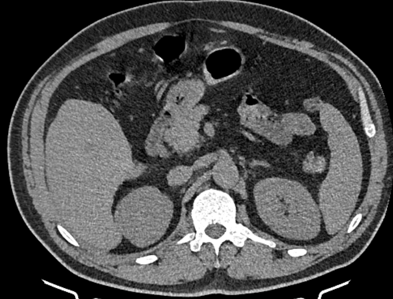 Cardiogenic pulmonary edema (Radiopaedia 68180-77678 Axial non-contrast 70).jpg