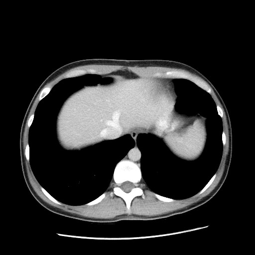 Castleman disease with fibrous pseudotumor in the abdomen (Radiopaedia 77296-89373 A 15).jpg