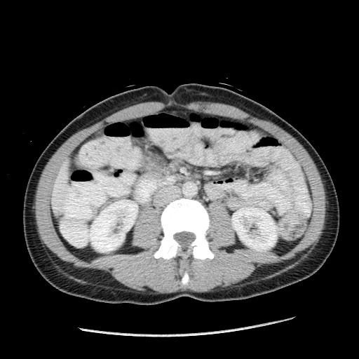 Castleman disease with fibrous pseudotumor in the abdomen (Radiopaedia 77296-89373 A 63).jpg