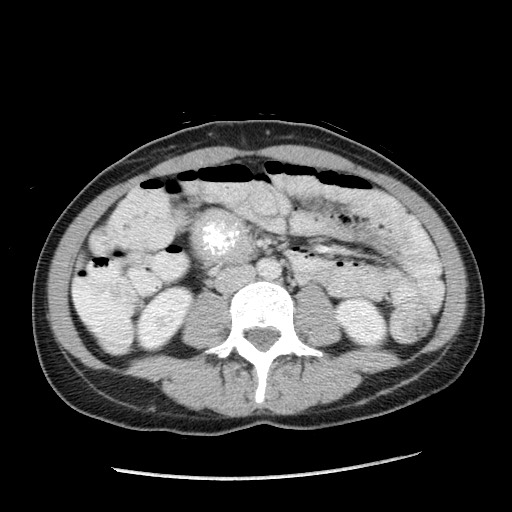 Castleman disease with fibrous pseudotumor in the abdomen (Radiopaedia 77296-89373 A 67).jpg