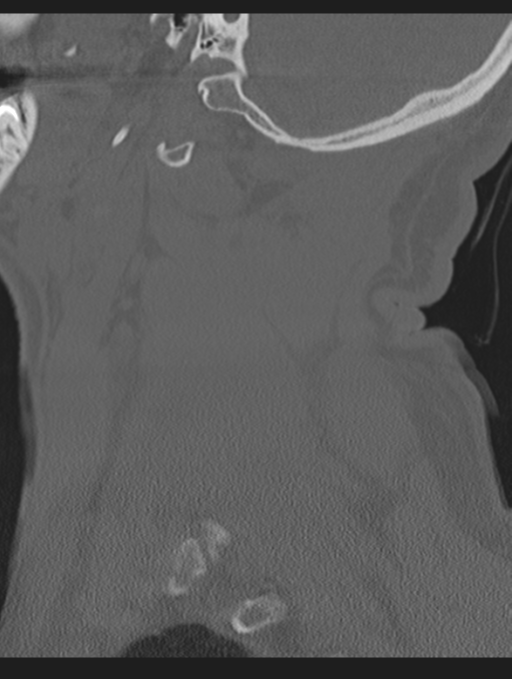 Cavernoma of cervical cord (Radiopaedia 50838-56346 Sagittal bone window 16).png