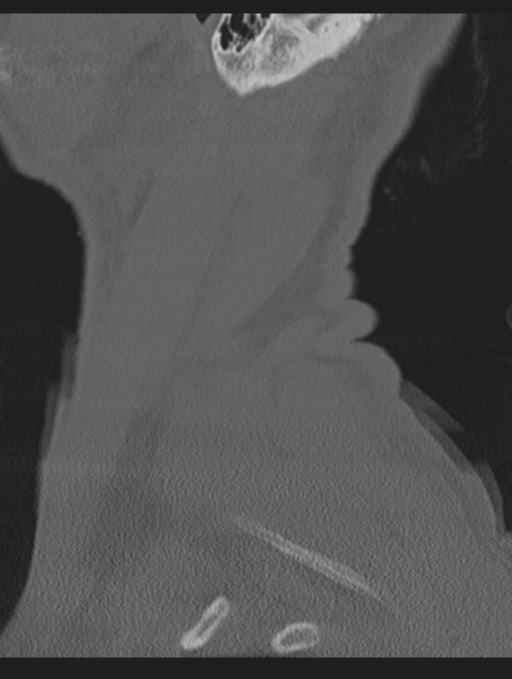 Cavernoma of cervical cord (Radiopaedia 50838-56346 Sagittal bone window 77).png