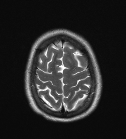 File:Cavernoma with bleed - midbrain (Radiopaedia 54546-60774 Axial T2 24).png