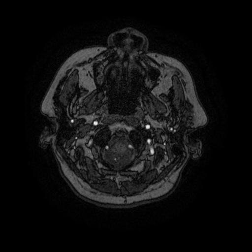 Cavernoma with developmental venous anomaly (Radiopaedia 22470-22507 MRA 104).jpg