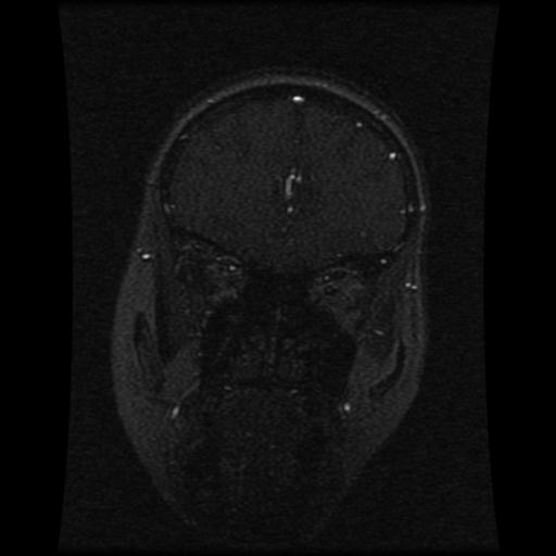 Cavernoma with developmental venous anomaly (Radiopaedia 22470-22507 MRV 99).jpg