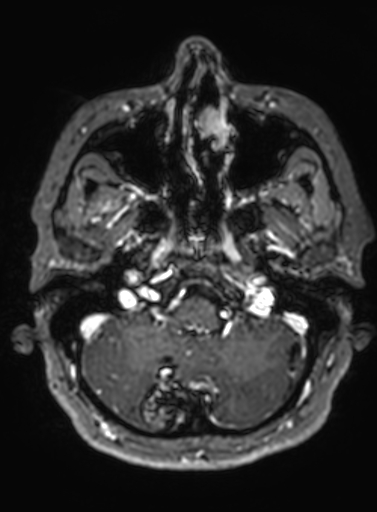 Cavernous hemangioma of the cerebellar falx (Radiopaedia 73025-83724 Axial T1 C+ 278).jpg