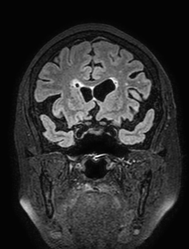 Cavernous hemangioma of the cerebellar falx (Radiopaedia 73025-83724 Coronal FLAIR 114).jpg