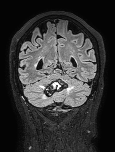 Cavernous hemangioma of the cerebellar falx (Radiopaedia 73025-83724 Coronal FLAIR 261).jpg