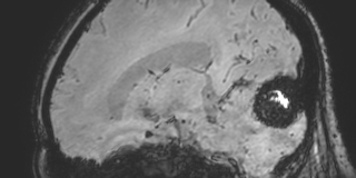 Cavernous hemangioma of the cerebellar falx (Radiopaedia 73025-83724 Sagittal BOLD 121).jpg