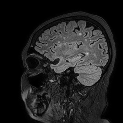 File:Cavernous hemangioma of the cerebellar falx (Radiopaedia 73025-83724 Sagittal FLAIR 52).jpg
