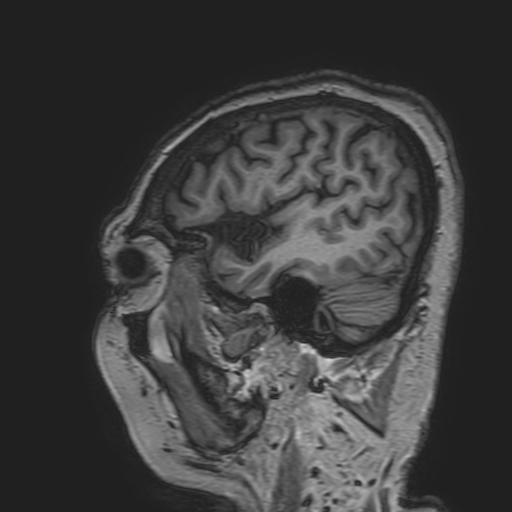 File:Cavernous hemangioma of the cerebellar falx (Radiopaedia 73025-83724 Sagittal T1 40).jpg