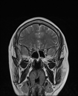 File:Cavernous sinus meningioma (Radiopaedia 63682-72367 Coronal T2 2).jpg