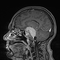 Cavernous sinus meningioma (Radiopaedia 63682-72367 Sagittal T1 C+ 83).jpg