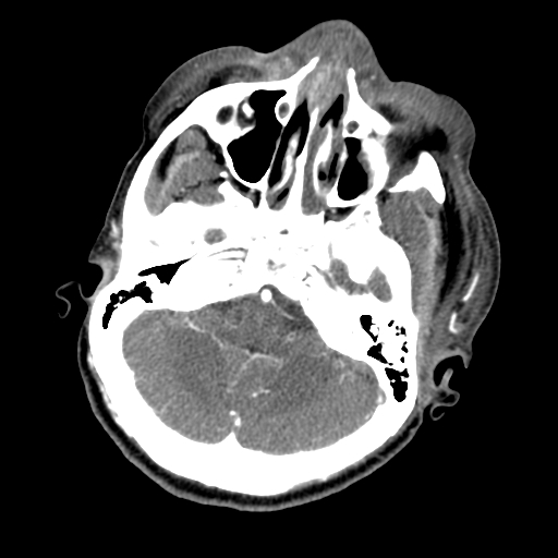 File:Cavernous sinus thrombosis (Radiopaedia 10619-11078 A 6).jpg