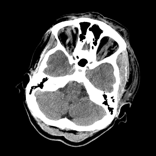 File:Cavernous sinus thrombosis (Radiopaedia 10619-11078 Axial non-contrast 10).jpg