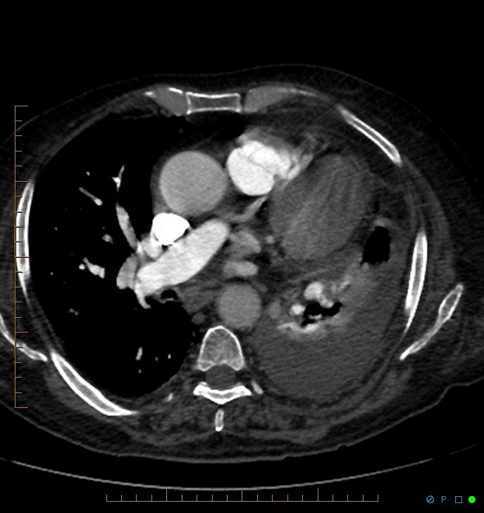 Cavitating pulmonary infarction (Radiopaedia 54634-60849 Axial C+ CTPA 42).jpg