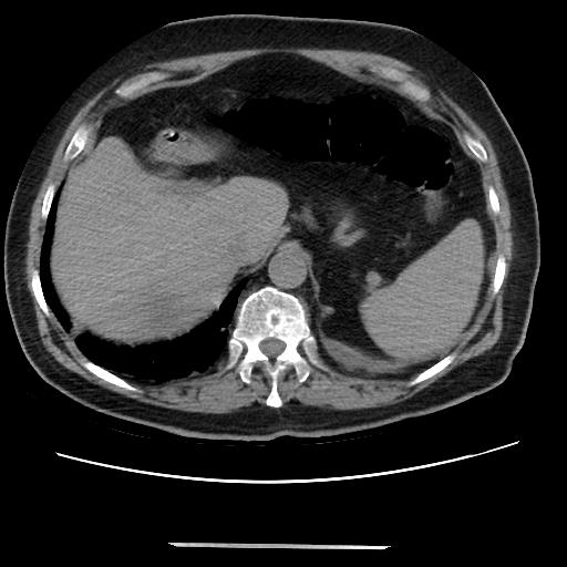 Cavitating pulmonary metastases (Radiopaedia 89545-106544 Axial non-contrast 52).jpg