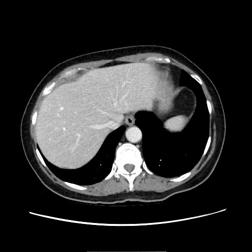 Cecal adenocarcinoma (Radiopaedia 75909-87331 A 19).jpg