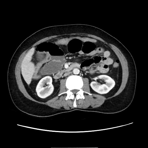 Cecal adenocarcinoma (Radiopaedia 75909-87331 A 43).jpg