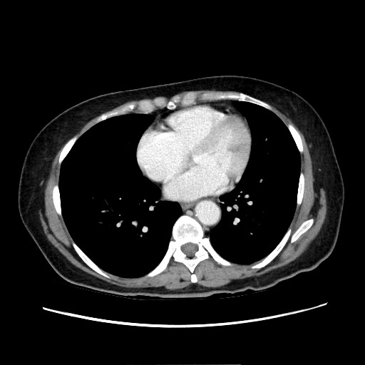 Cecal adenocarcinoma (Radiopaedia 75909-87331 A 8).jpg