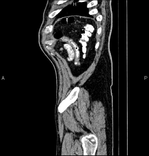Cecal adenocarcinoma (Radiopaedia 85324-100916 E 87).jpg