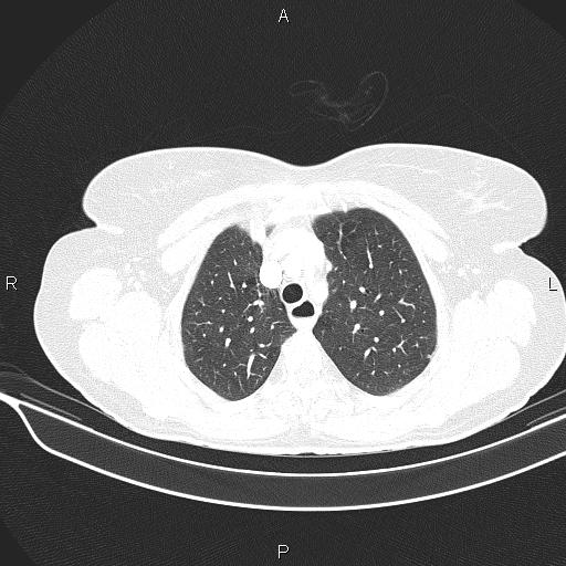 Cecal cancer (Radiopaedia 85610-101358 Axial lung window 16).jpg