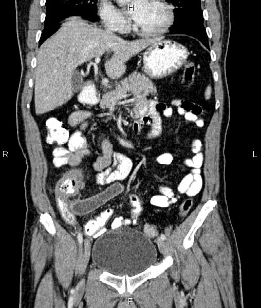 Cecal cancer with appendiceal mucocele (Radiopaedia 91080-108651 D 29).jpg