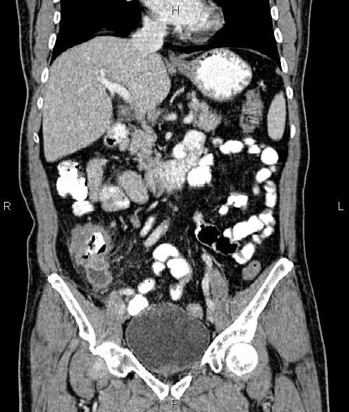 Cecal cancer with appendiceal mucocele (Radiopaedia 91080-108651 D 34).jpg