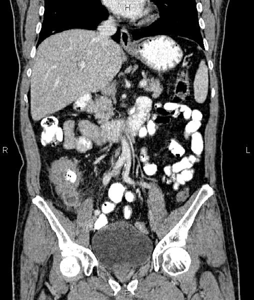 Cecal cancer with appendiceal mucocele (Radiopaedia 91080-108651 D 36).jpg