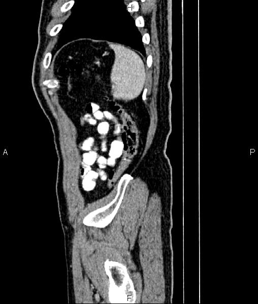 File:Cecal cancer with appendiceal mucocele (Radiopaedia 91080-108651 E 86).jpg