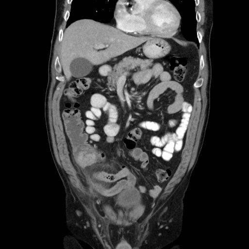 File:Cecal mass causing appendicitis (Radiopaedia 59207-66531 B 18).jpg