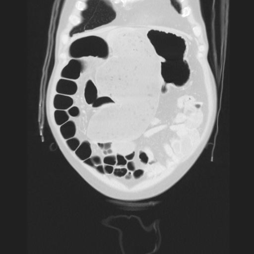 Cecal volvulus (Radiopaedia 75378-86620 Coronal lung window 38).jpg