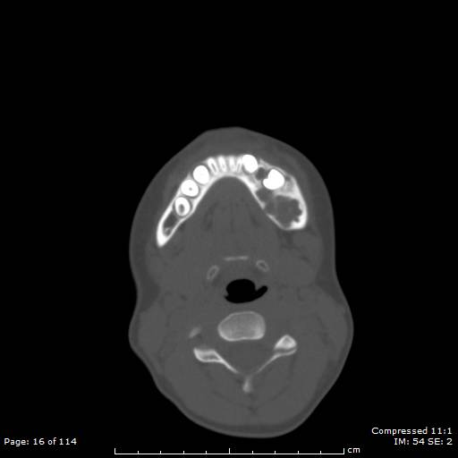 File:Central giant cell granuloma (Radiopaedia 45612-49754 Axial bone window 8).jpg