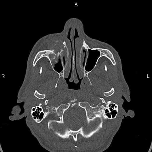 File:Central giant cell granuloma (Radiopaedia 83346-97761 Axial bone window 37).jpg