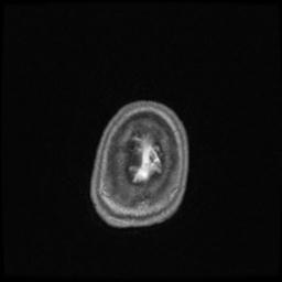 Central neurocytoma (Radiopaedia 30220-30842 Axial T1 C+ 145).jpg