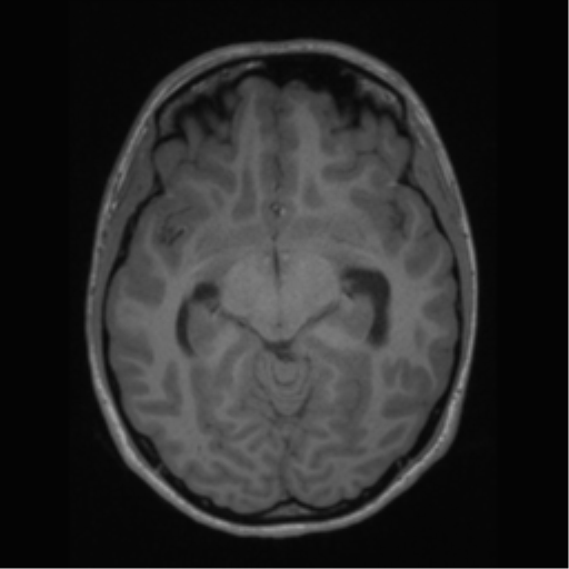 File:Central neurocytoma (Radiopaedia 37664-39557 Axial T1 30).png