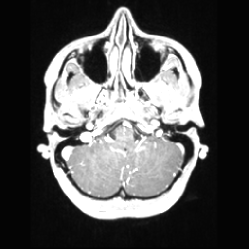 File:Central neurocytoma (Radiopaedia 37664-39557 Axial T1 C+ 17).png