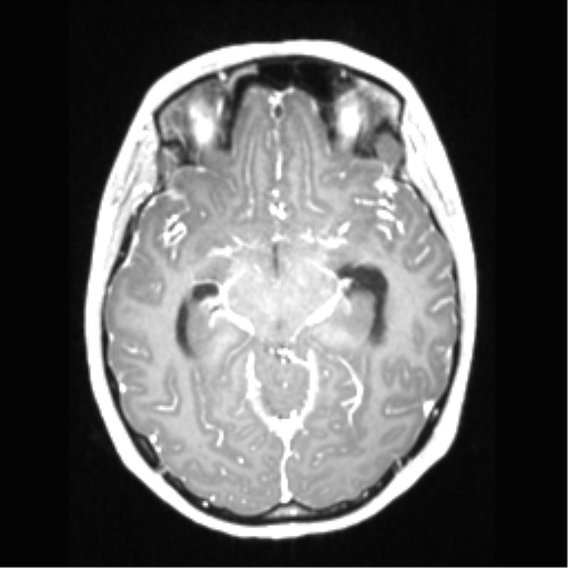 File:Central neurocytoma (Radiopaedia 37664-39557 Axial T1 C+ 34).png