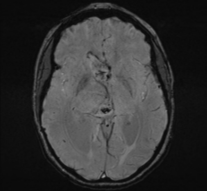 Central neurocytoma (Radiopaedia 70263-80336 Axial SWI 27).jpg