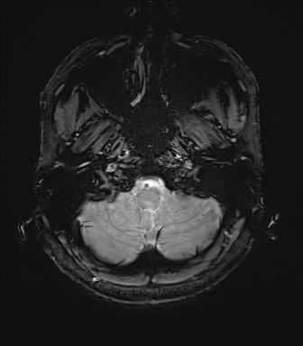 Central neurocytoma (Radiopaedia 71068-81303 Axial SWI 2).jpg