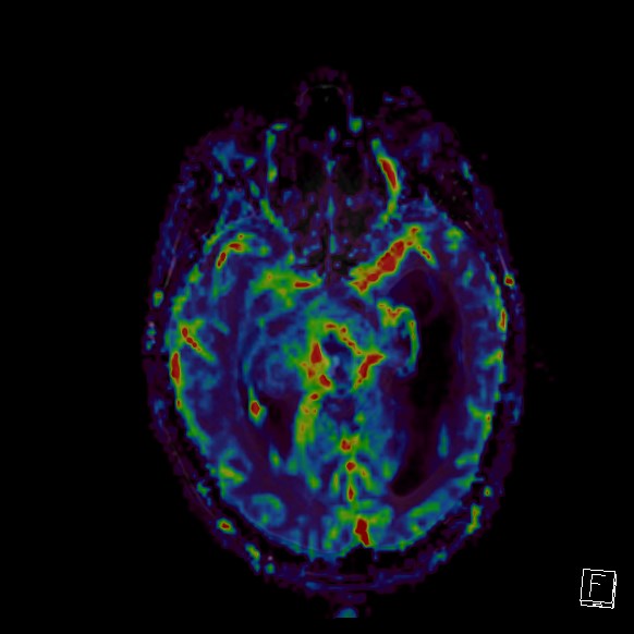 Central neurocytoma (Radiopaedia 84497-99872 Axial Perfusion 188).jpg