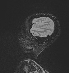 Central neurocytoma (Radiopaedia 84497-99872 Sagittal Flair + Gd 133).jpg