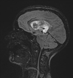 Central neurocytoma (Radiopaedia 84497-99872 Sagittal Flair + Gd 74).jpg