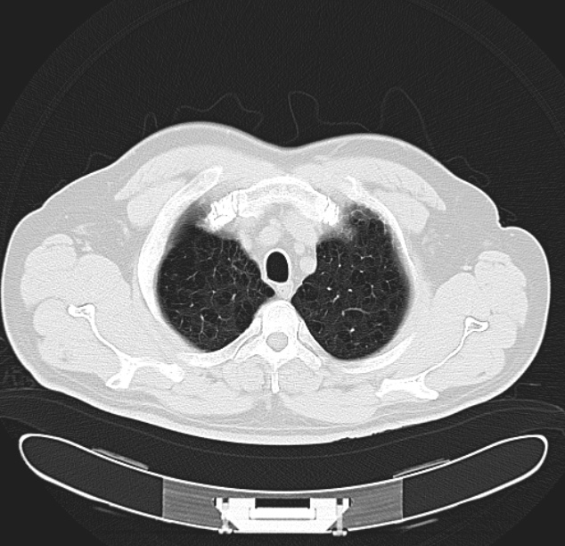 Centrilobular pulmonary emphysema (Radiopaedia 26808-26971 C 6).jpg