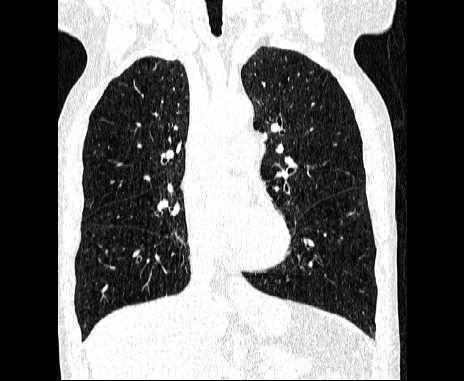 Centrilobular pulmonary emphysema (Radiopaedia 62468-70718 Coronal lung window 32).jpg