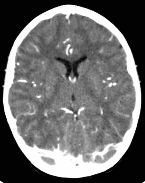Cerebellar abscess (Radiopaedia 73727-84527 Axial C+ 42).jpg