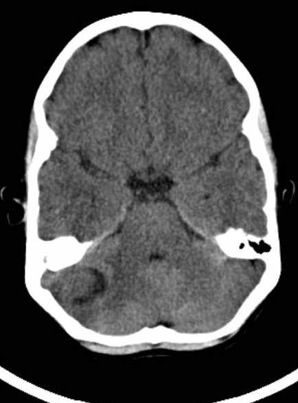 Cerebellar abscess (Radiopaedia 73727-84527 Axial non-contrast 30).jpg