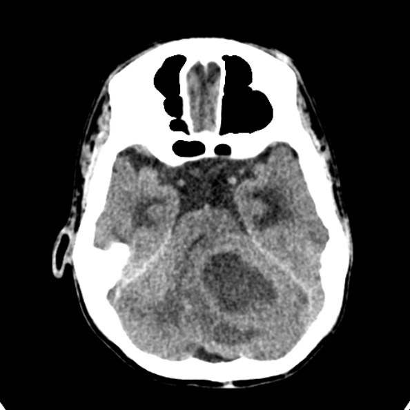 Cerebellar abscess secondary to mastoiditis (Radiopaedia 26284-26412 Axial non-contrast 48).jpg