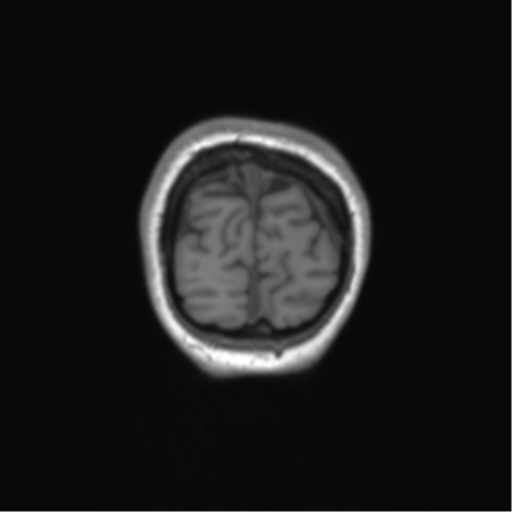Cerebellar agenesis with hypoplastic pons (pontocerebellar hypoplasia) (Radiopaedia 57224-64138 Coronal T1 10).png