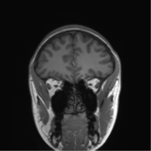 Cerebellar agenesis with hypoplastic pons (pontocerebellar hypoplasia) (Radiopaedia 57224-64138 Coronal T1 71).png